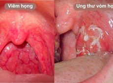 Ung thư vòm họng giai đoạn đầu: Dấu hiệu, chẩn đoán, điều trị